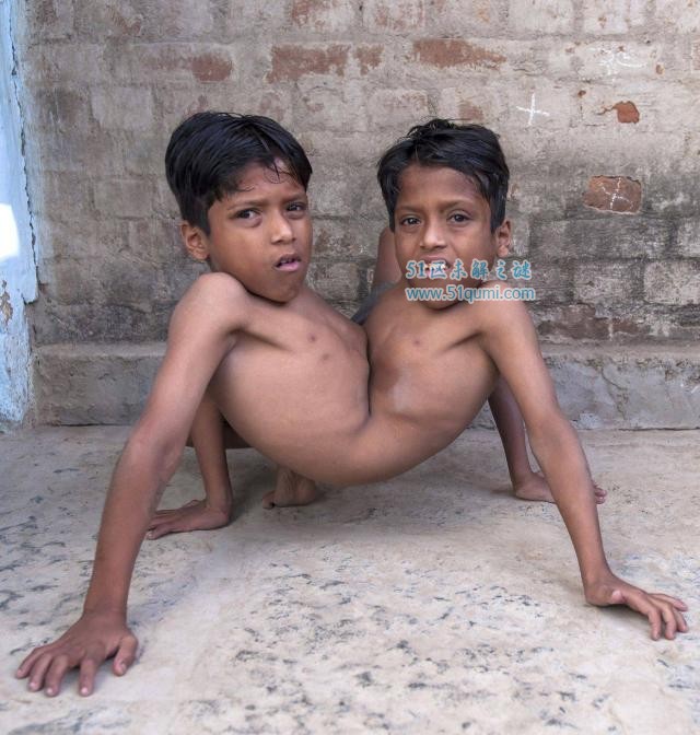 印度连体兄弟拒绝分离 兄弟两人共享4只胳膊和2条腿